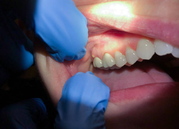 Best Dentist for Tooth Abscess  in West Cape May, NJ